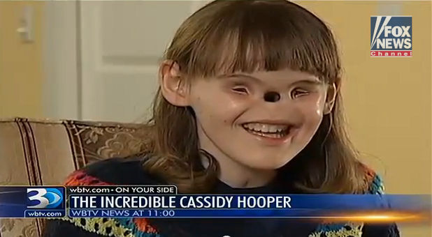 Teen Born Without Nose or Eyes Inspires Masses