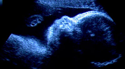 ultrasound of baby