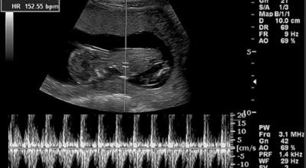 fetal heartbeat