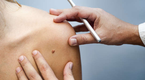 Melanoma is responsible for about 9,000 deaths per year in the U.S.