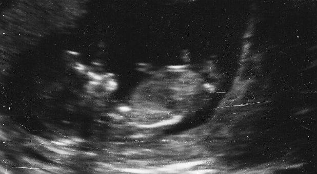 This ultrasound proves the person in the womb is just that, a person.