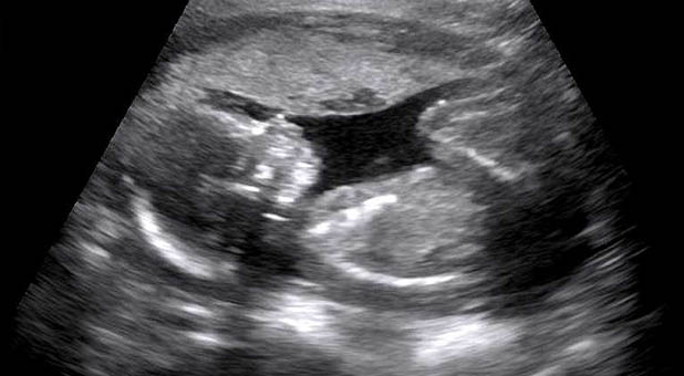 Ultrasound of Unborn Baby