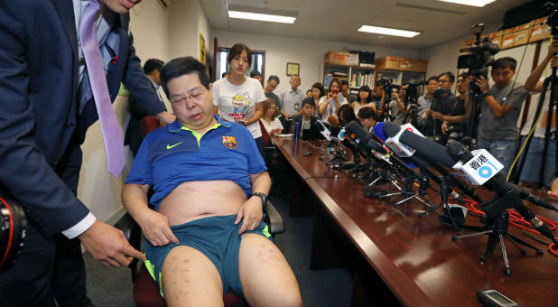 Democratic Party member Howard Lam shows off his injury at a news conference in Hong Kong, China.